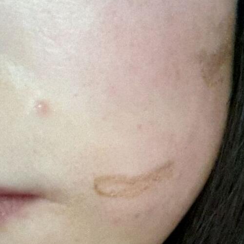 兩次激光祛疤過程圖片分享給大家做割參考