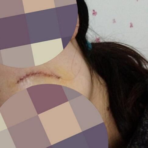 給大家看看我的臉上的手術(shù)切除祛疤過程圖片