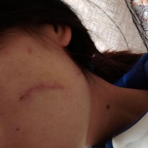 給大家看看我的臉上的手術(shù)切除祛疤過程圖片