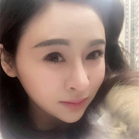 自體脂肪填充面部前后過(guò)程以及對(duì)比照片，真實(shí)案例分享