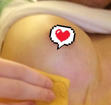 自體脂肪隆胸落實我擁有豐滿美胸的愿望