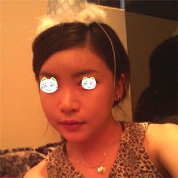 分享美立方做下頜角整形手術(shù)經(jīng)歷，還有前后對比果圖片哦~