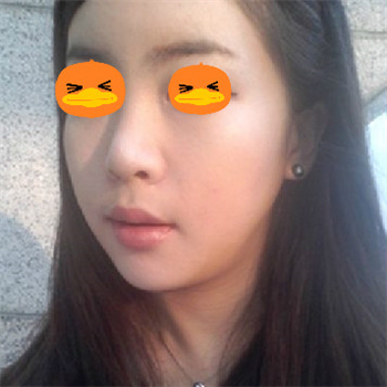 分享美立方做下頜角整形手術(shù)經(jīng)歷，還有前后對比果圖片哦~