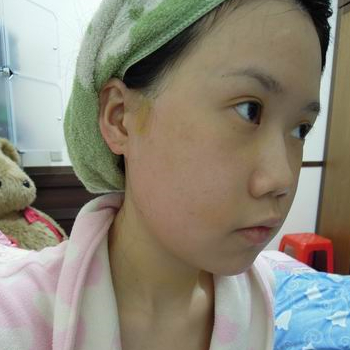 磨下頜角面部輪廓整形上個月，分享恢復(fù)過程和對比照片哦~