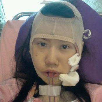 磨下頜角面部輪廓整形上個月，分享恢復(fù)過程和對比照片哦~