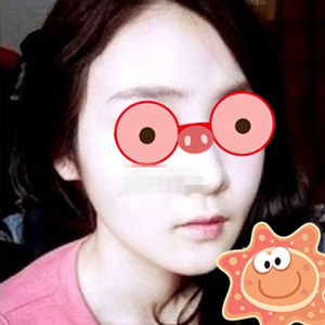 南相宰磨下頜角手術(shù)恢復(fù)過程分享，還有前后對比圖片哦~