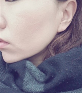 電波l皮緊膚除皺，的確是年輕了不少