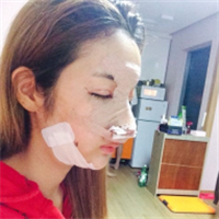 去年做的鷹鉤鼻矯正+面部脂肪填充，分享術(shù)后照片~