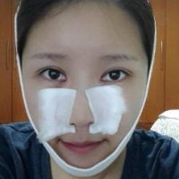 做了埋線雙眼皮、隆鼻、磨下頜角，兩個(gè)月了，分享恢復(fù)照片~