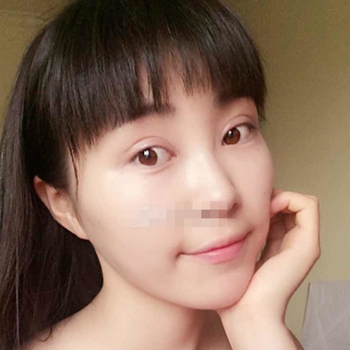 開外眼角手術(shù)一個(gè)月了，分享恢復(fù)過程和前后對比果照片~