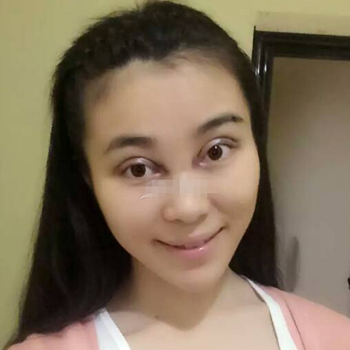 開外眼角手術(shù)一個(gè)月了，分享恢復(fù)過程和前后對比果照片~