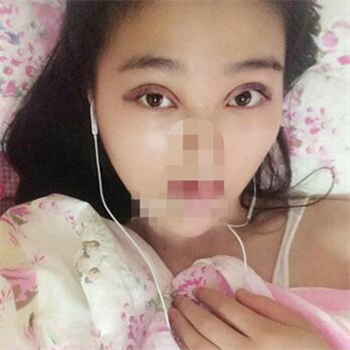 開外眼角手術(shù)一個(gè)月了，分享恢復(fù)過程和前后對比果照片~