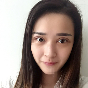 伊美馨做了開內(nèi)眼角和雙眼皮手術(shù)，分享我的術(shù)后果照片~~