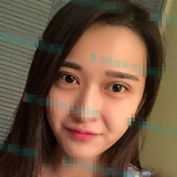 伊美馨做了開內(nèi)眼角和雙眼皮手術(shù)，分享我的術(shù)后果照片~~