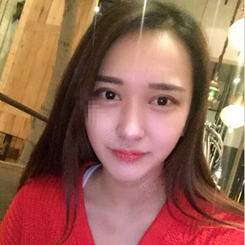 伊美馨做了開內(nèi)眼角和雙眼皮手術(shù)，分享我的術(shù)后果照片~~