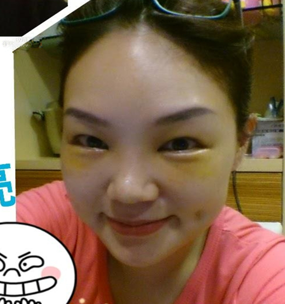 李阿姨眼袋失敗修復手術(shù)后的果圖，年輕了好幾歲~