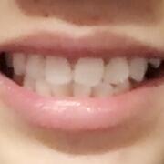 美容冠牙齒修復(fù)，緩解前后過(guò)程分享