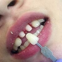 氧化鋯烤瓷牙價(jià)格5600元兩顆，果很滿意