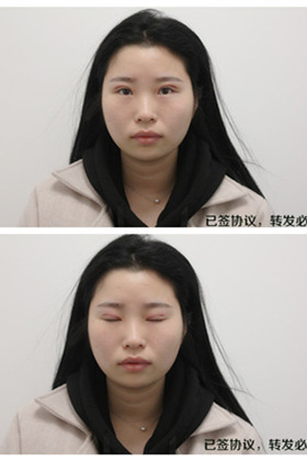 剛做了雙眼皮切開(kāi)重瞼手術(shù)，恢復(fù)得越來(lái)越自然了