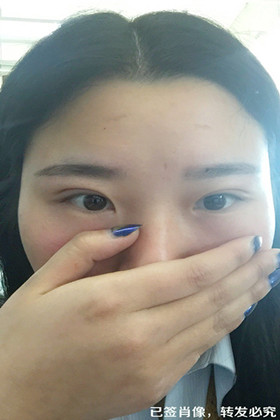 剛做了雙眼皮切開(kāi)重瞼手術(shù)，恢復(fù)得越來(lái)越自然了