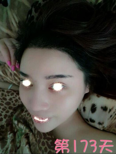 植發(fā)拯救了我的高發(fā)際線 果很棒哦**