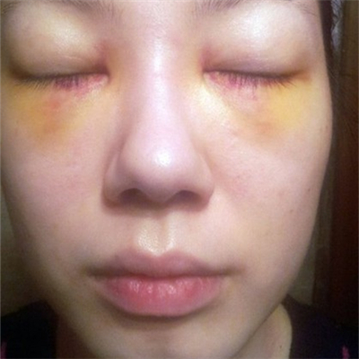 激光溶脂去眼袋恢復(fù)過程和前后對比果圖片分享哦~