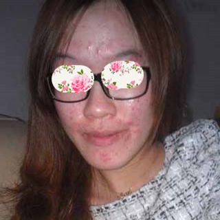 激光祛痘手術(shù)恢復(fù)過程分享，還有前后對(duì)比果圖片哦~