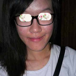 激光祛痘手術(shù)恢復(fù)過程分享，還有前后對(duì)比果圖片哦~