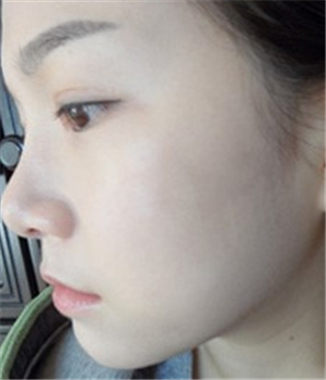 元旦做的光子嫩膚，分享恢復過程和前后對比果照片哦~