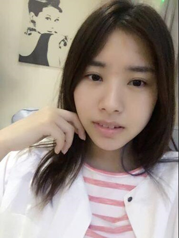 玻尿酸豐下巴果還不錯(cuò) 過幾個(gè)月就做假體隆下巴