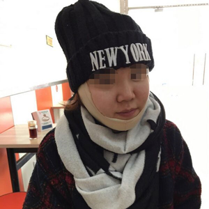 吸脂瘦臉手術(shù)半年了，分享前后對比果照片~