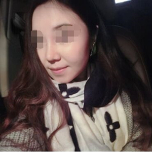 吸脂瘦臉手術(shù)半年了，分享前后對比果照片~