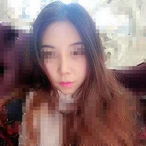 吸脂瘦臉手術(shù)半年了，分享前后對比果照片~