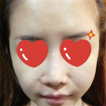 做音波拉皮除皺術(shù)一個(gè)月了，分享恢復(fù)過(guò)程和前后對(duì)比果圖片~