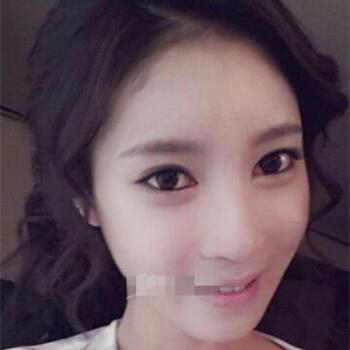 長沙美萊做了磨顴骨手術(shù)，分享恢復(fù)過程和前后對比果圖片~