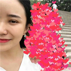 北京美萊做了雙眼皮手術(shù)，分享前后對比果圖片~