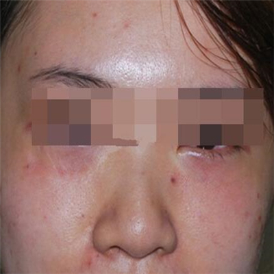 內切去眼袋手術恢復過程和前后對比果圖片分享，美聯臣做的哦~