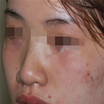 內切去眼袋手術恢復過程和前后對比果圖片分享，美聯臣做的哦~