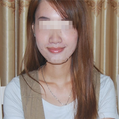 內切去眼袋手術恢復過程和前后對比果圖片分享，美聯臣做的哦~