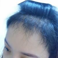 在雍禾植發(fā)醫(yī)院做微創(chuàng)微創(chuàng)植發(fā)經(jīng)歷分享，植發(fā)果很好