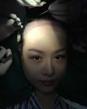 植發(fā)手術(shù)，將健康毛發(fā)組織移植到前額