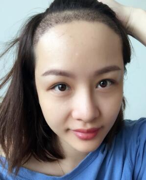 植發(fā)，種發(fā)際線真實案例分享