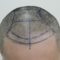 北京微創(chuàng)植發(fā)價格23800元，植發(fā)過程多圖對比分享