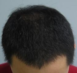 植發(fā)4個月了，期間有正常脫發(fā)