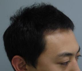 植發(fā)半年了，頭發(fā)沒有再掉落的情況，用手扒扯了一下，長的很牢固