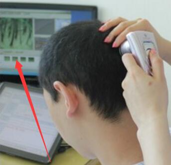 醫(yī)生檢查頭皮和毛囊的圖片