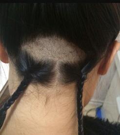 眉毛種植取毛囊