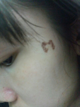 激光祛斑，還我靚白肌膚!