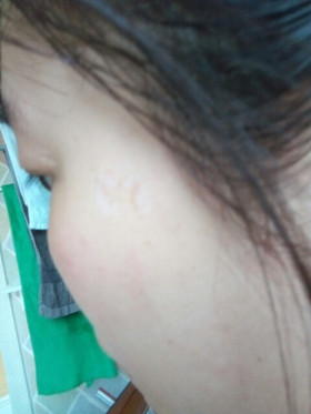 激光祛斑，還我靚白肌膚!