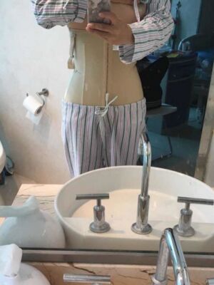 腰腹吸脂整形對(duì)比圖 肚子小了很多